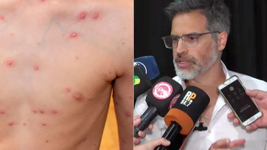 Confirman un brote de varicela en Entre Ríos: hay 700 casos y la mayoría son adolescentes