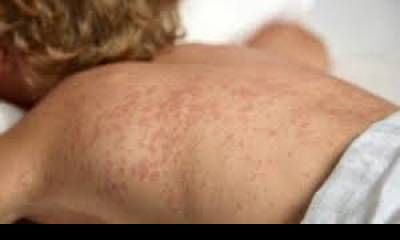 Alerta por sarampión: Nación investiga posibles contactos en Entre Ríos tras el paso de viajeros uruguayos.