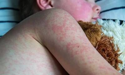 Registraron siete casos sospechosos de sarampión en lo que va del año en Entre Ríos