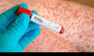 Entre Ríos registró 1.029 casos de sífilis en 2025