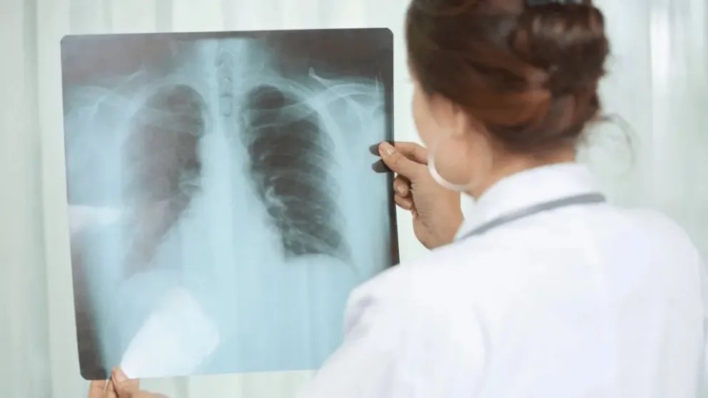 Alerta sanitaria en Entre Ríos: Los casos de tuberculosis aumentaron casi un 39% en lo que va de 2026