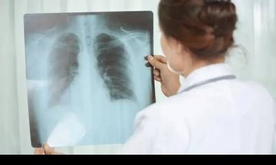 Alerta sanitaria en Entre Ríos: Los casos de tuberculosis aumentaron casi un 39% en lo que va de 2026